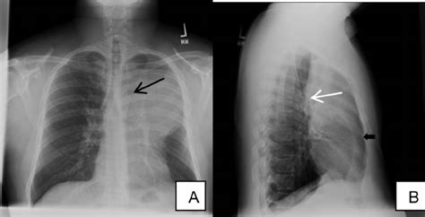 apicolordotic view meaning|LEFT UPPER LOBE OPACITY: A DIAGNOSTIC DILEMMA.